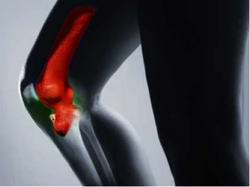 prostate cancer,silybum,artificial joint,knee,femur,accident pain,a pistol shaped gland,metal implants,aesculapian,light fractural,knee pad,incontinence aid,sacral,chili pepper,red chili pepper,bladder cherry,testicular cancer,tail light,caprese,cellulite