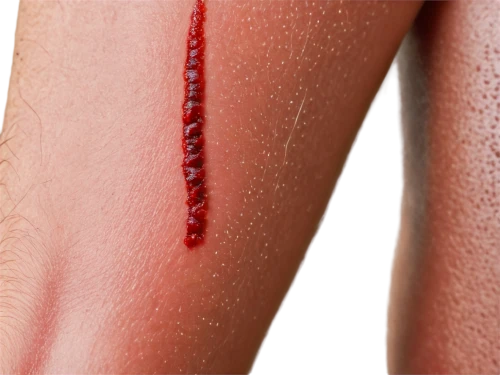 haemorrhages,laceration,abrasions,lacerations,hemorrhages,hemophilia,thrombophlebitis,wounds,pityriasis,cellulitis,physical injury,neosporin,excoriation,membranacea,gashes,phlebitis,cortisone,gashed,hemophiliac,scarification,Illustration,Realistic Fantasy,Realistic Fantasy 04