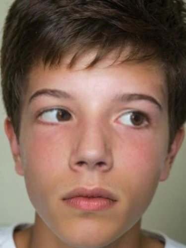 strabismus,graser,keratoconjunctivitis,retinoblastoma,speleers,summerall,marter,conjunctivitis,conner,exophthalmos,hayes,bastiaan,raviv,matthijs,gijs,mcdonough,rigondeaux,cyclopes,augen,rewi