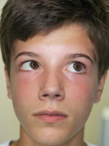 strabismus,graser,keratoconjunctivitis,conner,retinoblastoma,rigondeaux,sjc,arshavin,fetus,hayes,lautner,ansel,elgort,speleers,conjunctivitis,gaspard,thomaz,exophthalmos,ttd,summerall