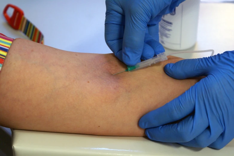 a person getting laser tattoo removal from the arm