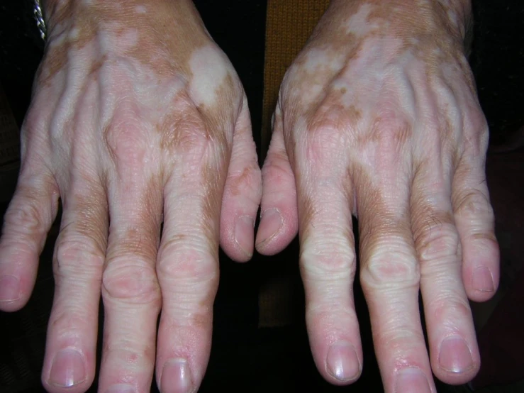 two hands with dirty spots are shown with their skin visible