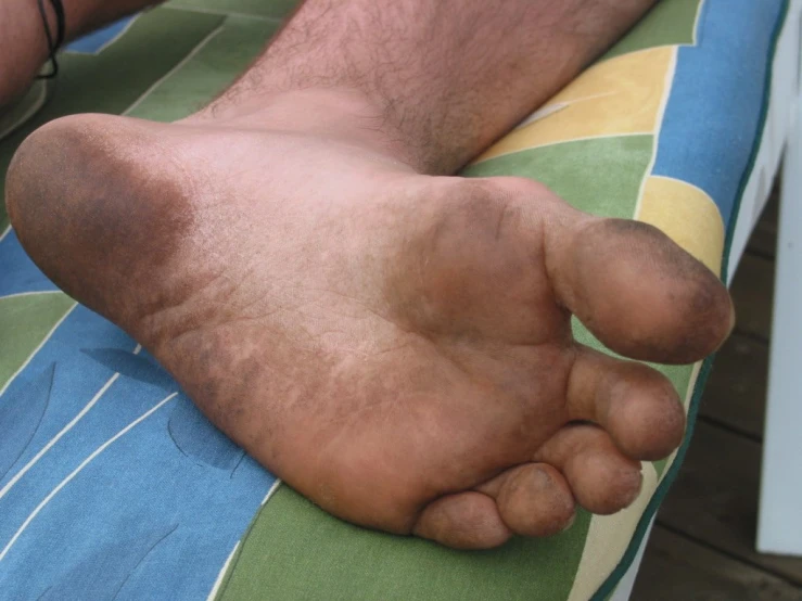 a person laying on their stomach, with a bruised foot