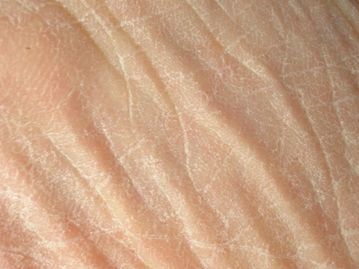 closeup view of a skin cancer on a human