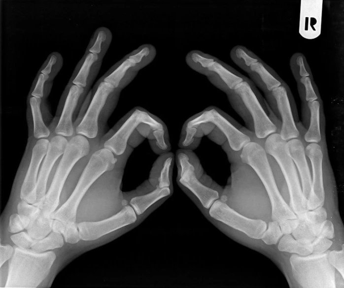 two hands, showing the xray pattern