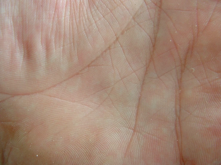 the palm of an older persons hand with frecky patterns