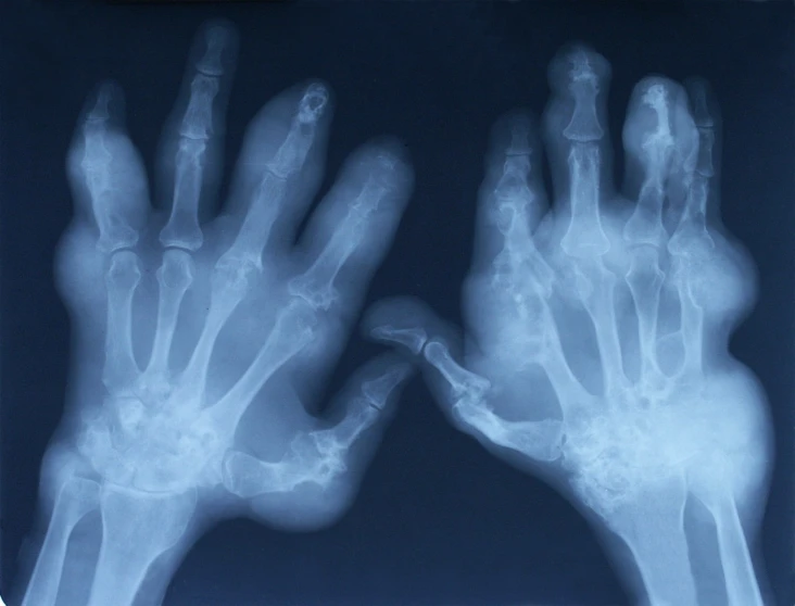 two hand x - rays showing different areas of the skeleton