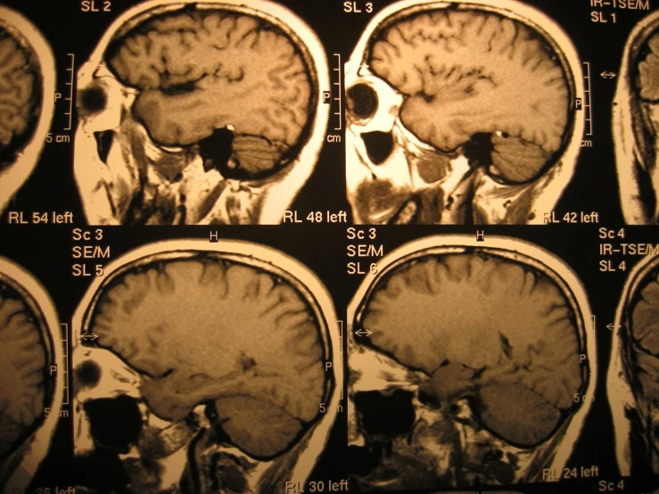 pictures of in mri mris showing normal and secondary areas of the human body