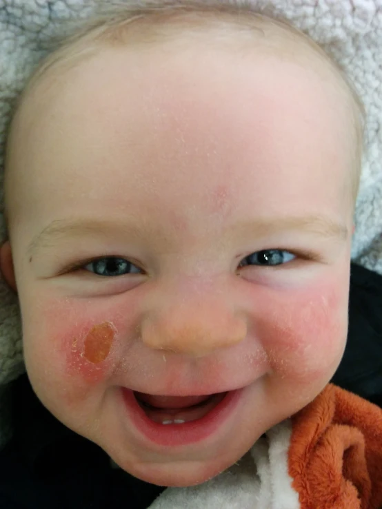 a smiling baby with yellow spots on it's cheek