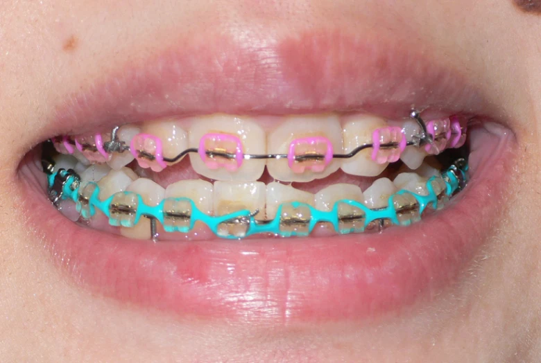 there is a very colorful teeth that has pastel blue on it