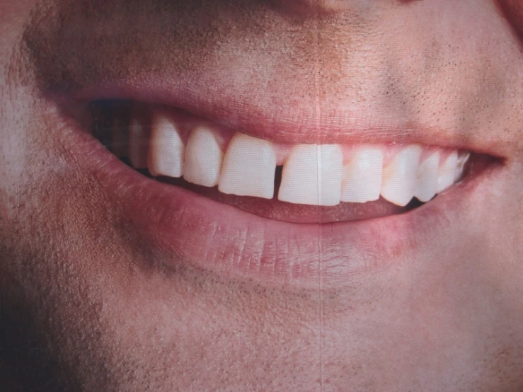 a close up of a person's mouth with toothbrushes in them