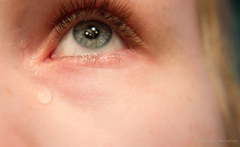 a womans eye has a lot of redness around it