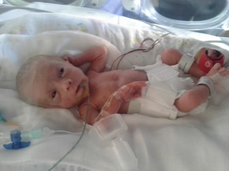 a baby on a hospital bed has an oxygen tube in his mouth