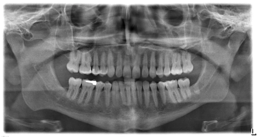 an x - ray image of teeth in the face of someone