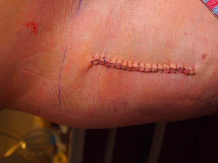 this stitchesed man has been removed from his left ankle