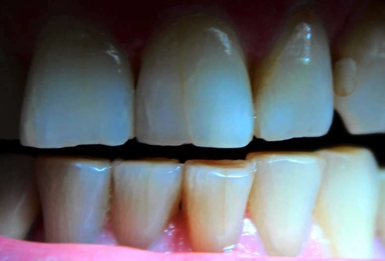 a smile after veneer removal with all porcelain teeth