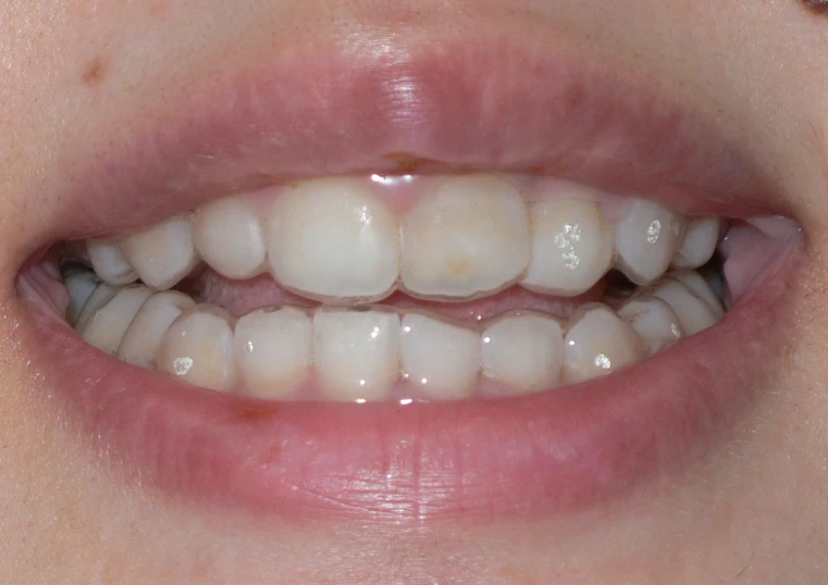 a woman's smile with tooth grafls on the lower half of her teeth