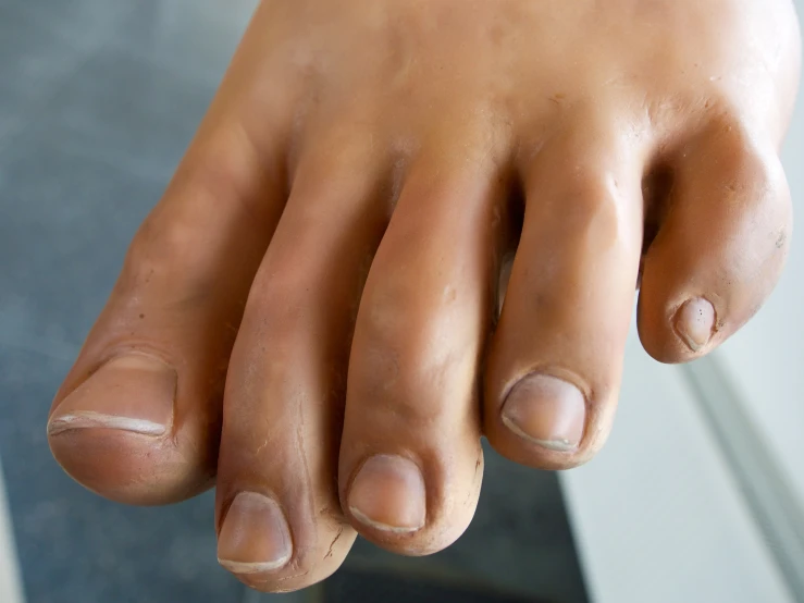 the bare toe of a person with black spots