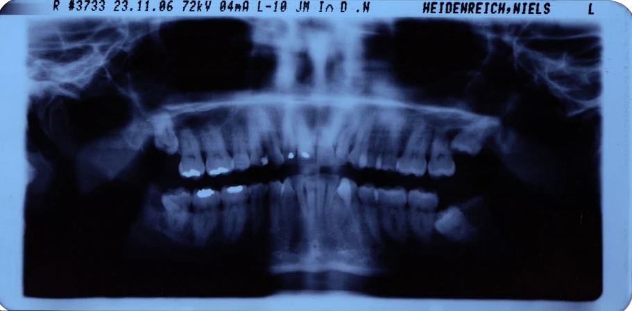 a tooth is shown in this blue and white po