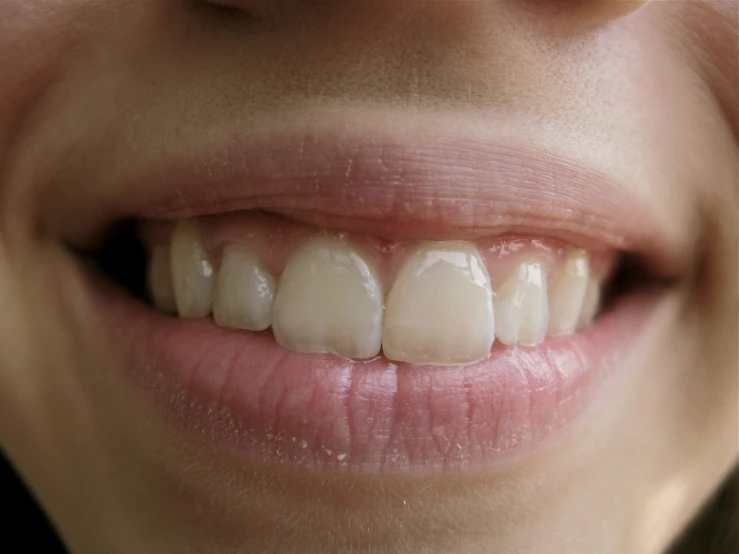 the woman's smile has white gums all over her mouth