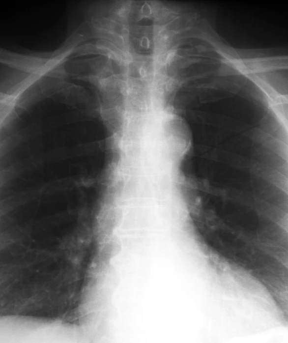 a medical radiograph showing an open lung