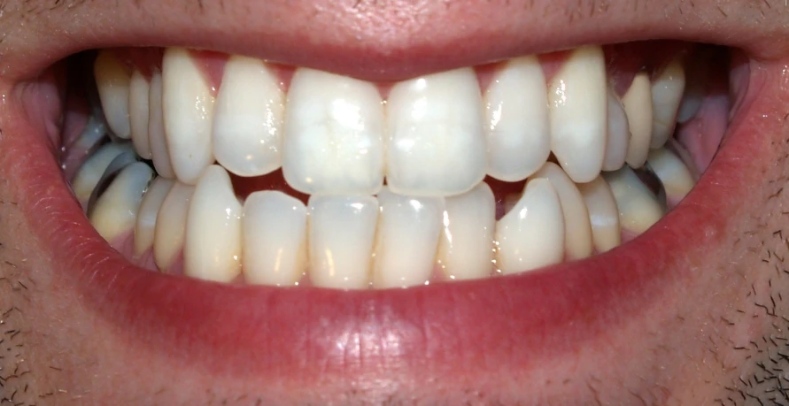 teeth that have been removed are whiter, slightly dented
