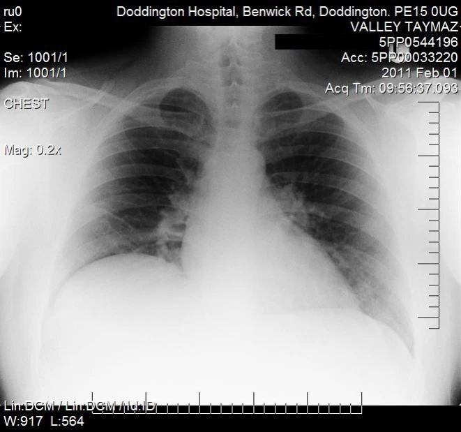 chest radiographs with chest radiogramics are not