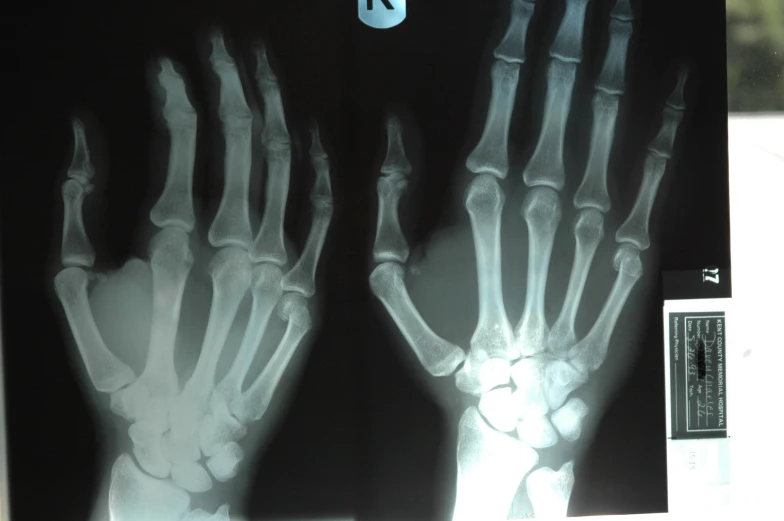 a x - ray of both hands holding up the top half