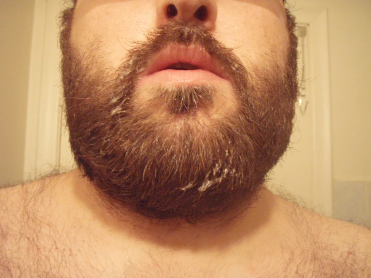 man with messy beard showing signs of hair loss