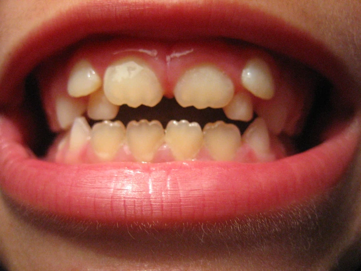 a close up of a person's teeth with tooth crowns
