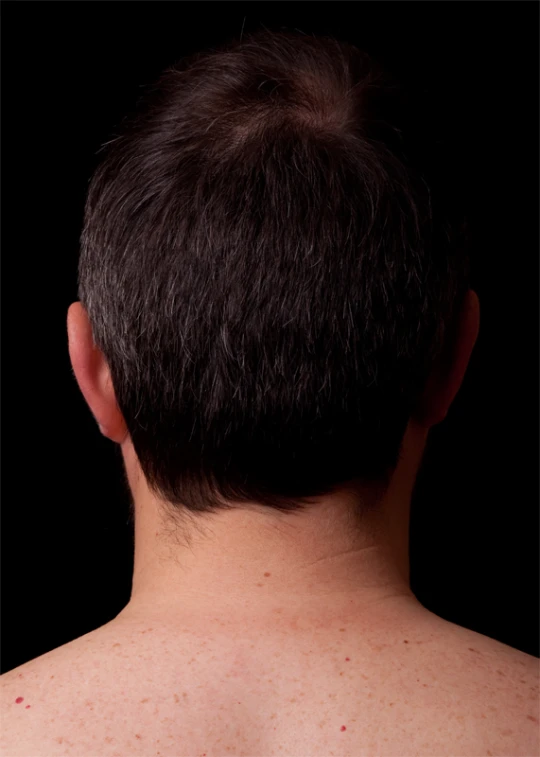 a man's back with freckled hair as if he is having some hair transplant