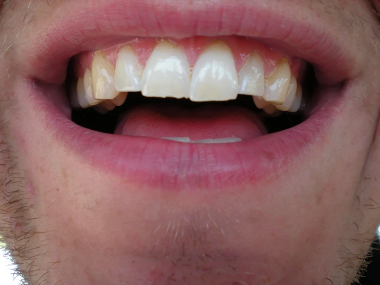 an open mouth with light colored teeth that has missing teeth