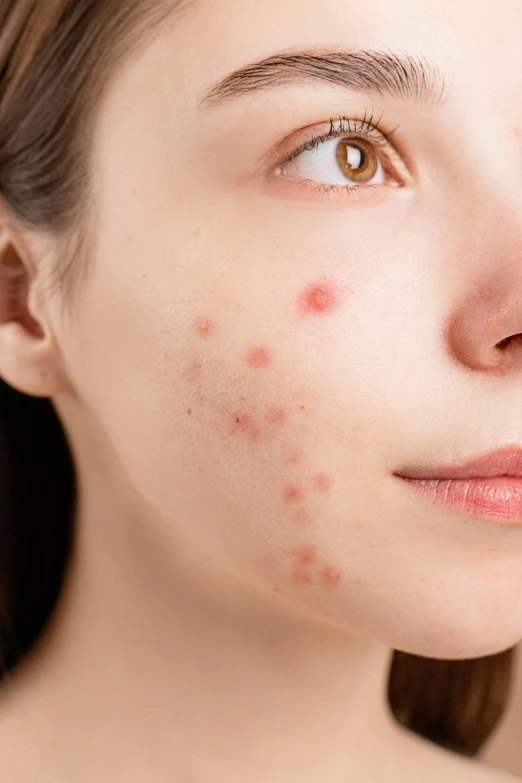 a woman with red spots on her face, by Adam Marczyński, shutterstock, antipodeans, square, 18 years old, bumps, bottom angle