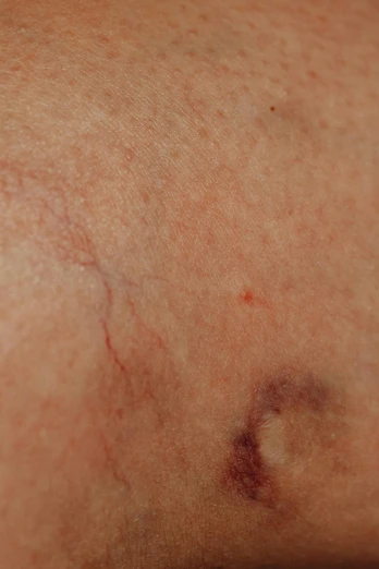 a close up of a person's arm with a wound on it, by Alison Watt, trending on reddit, sparse chest hair, mesh roots. closeup, high-resolution photo, red cheeks