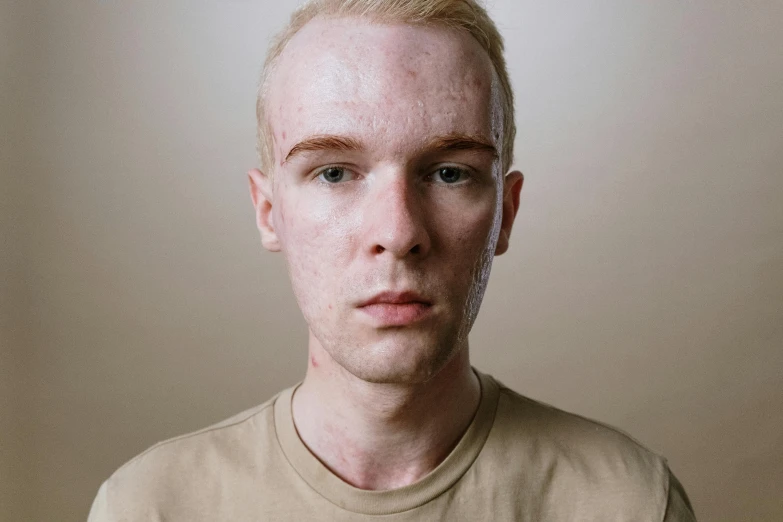 a close up of a person wearing a t - shirt, a character portrait, trending on pexels, hyperrealism, albino skin, thin scar on his forehead, light freckles, slender symmetrical face