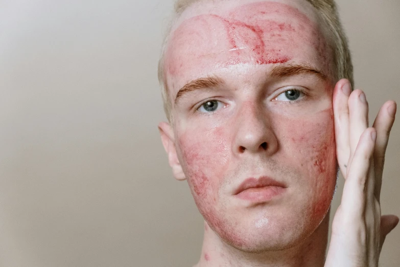 a man with a red spot on his face, by Adam Marczyński, trending on pexels, albino skin, acne, full body image, scratched