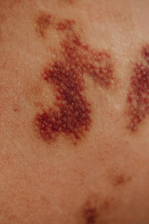 a close up of a person with a tattoo on their arm, a stipple, red birthmark, megascans, grape, as photograph