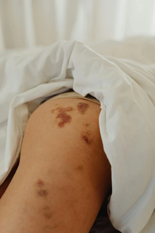 a close up of a person laying on a bed, by Elsa Bleda, trending on pexels, happening, bruises, round thighs, covered in runes, cysts