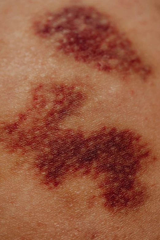 a close up of a person's arm with blood on it, a tattoo, surface hives, as photograph, raspberry, crosshatch