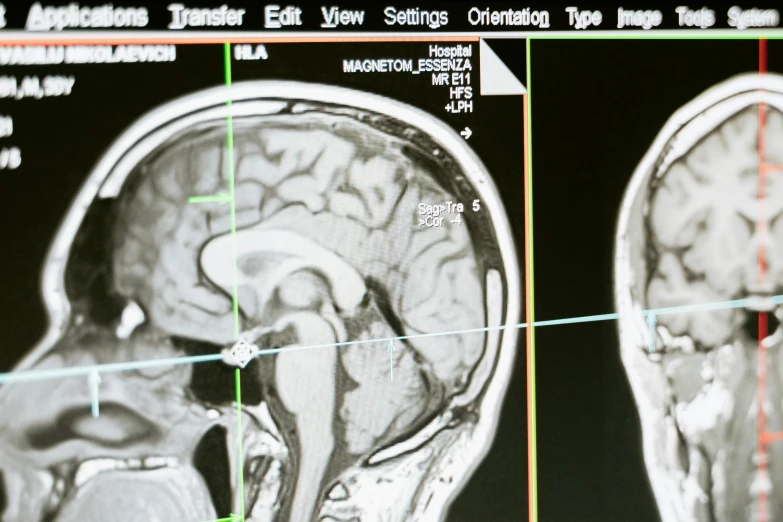 a close up of a person's brain scan, by Joe Bowler, ap art, tourist photo, 15081959 21121991 01012000 4k, 2000s photo