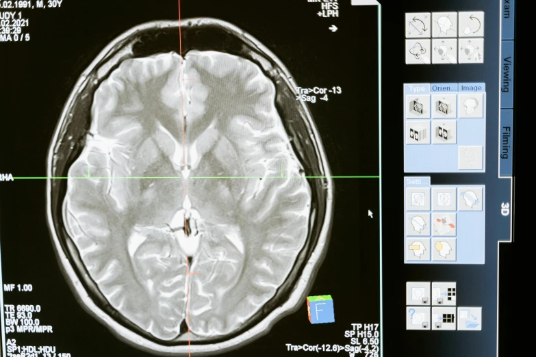 a close up of a person's brain scan, a digital rendering, unsplash, close-up print of fractured, high definition screenshot