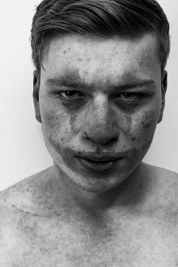 a black and white photo of a man with freckles on his face, reddit, hyperrealism, albino skin, sweating profusely, sadness personified, dasha taran