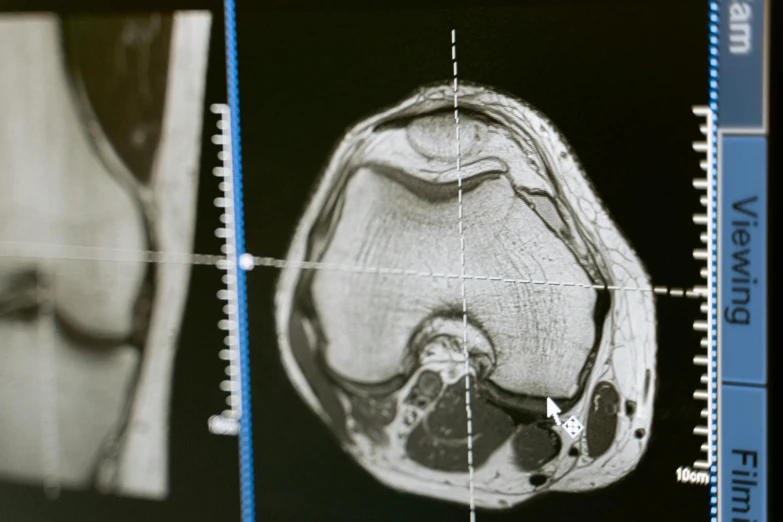 a close up of an x - ray of a person's knee, unsplash, massurrealism, wood print, mri, thumbnail, on an operating table