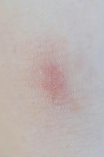 a close up of a person's skin with a red spot, by Alison Watt, square, full body shot close up, low quality photo, burn