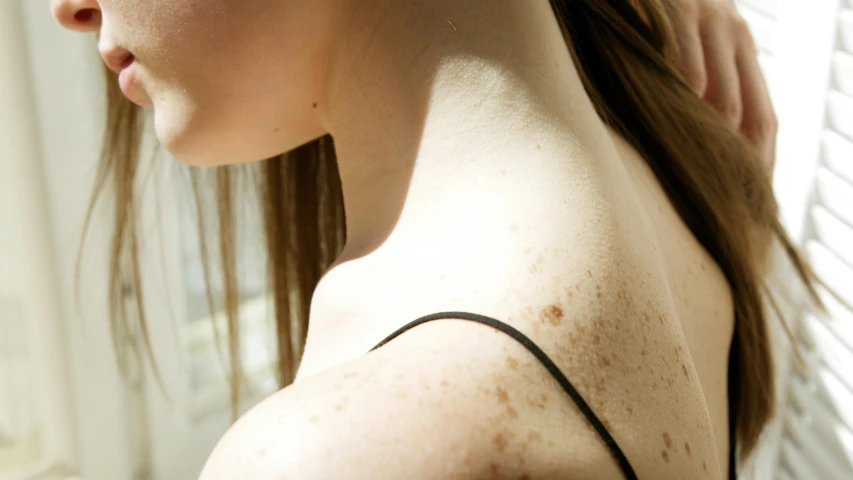 a woman with freckles standing in front of a window, a tattoo, by Gavin Hamilton, trending on pexels, with the sun shining on it, white with chocolate brown spots, on a young beautiful woman neck, shoulder