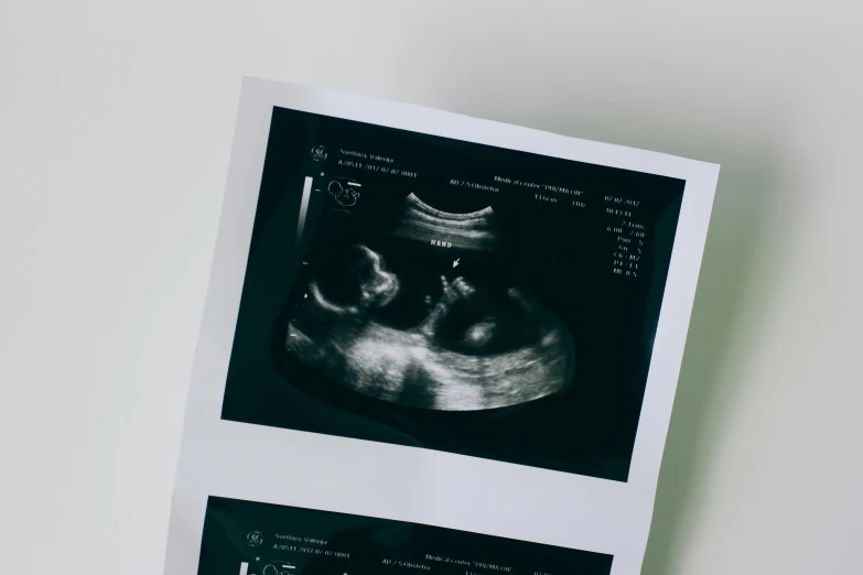 a black and white photo of a baby's ultrasound, unsplash, visual art, poster template on canva, 1990's photo, multiple stories, doctor