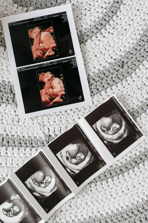 a couple of pictures sitting on top of a bed, a black and white photo, inspired by Margaret Geddes, trending on pexels, mri, fetus, photocopied, coloured photo