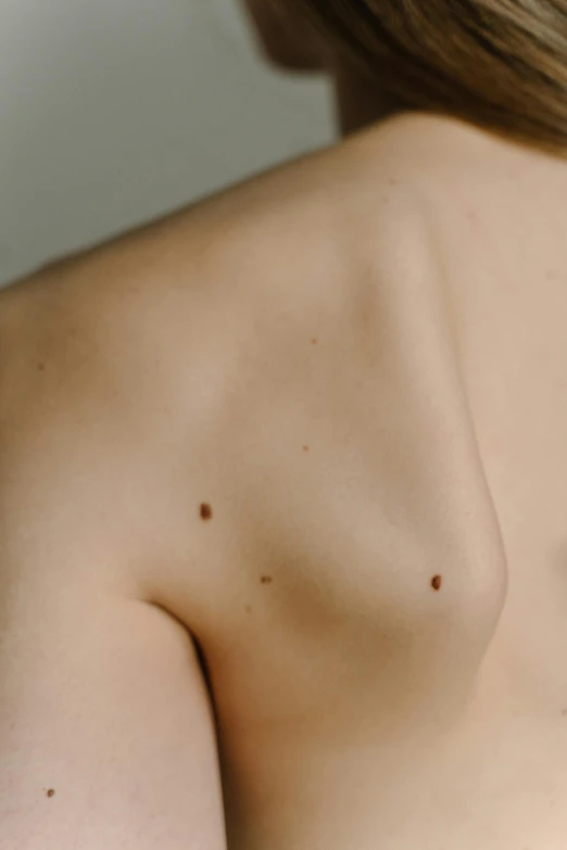 the back of a person with brown spots on her 