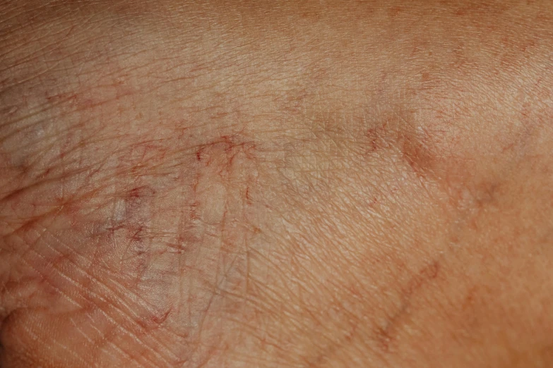 the red lines of an unhelved area on a woman's arm