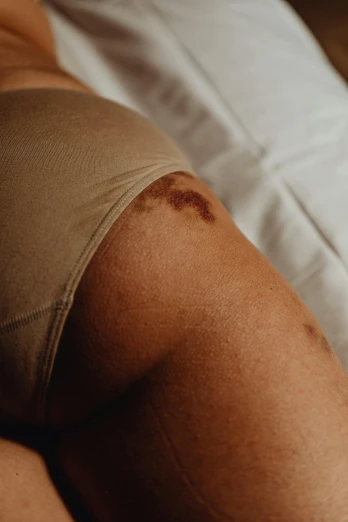 an arm with scars and  is displayed in a bed